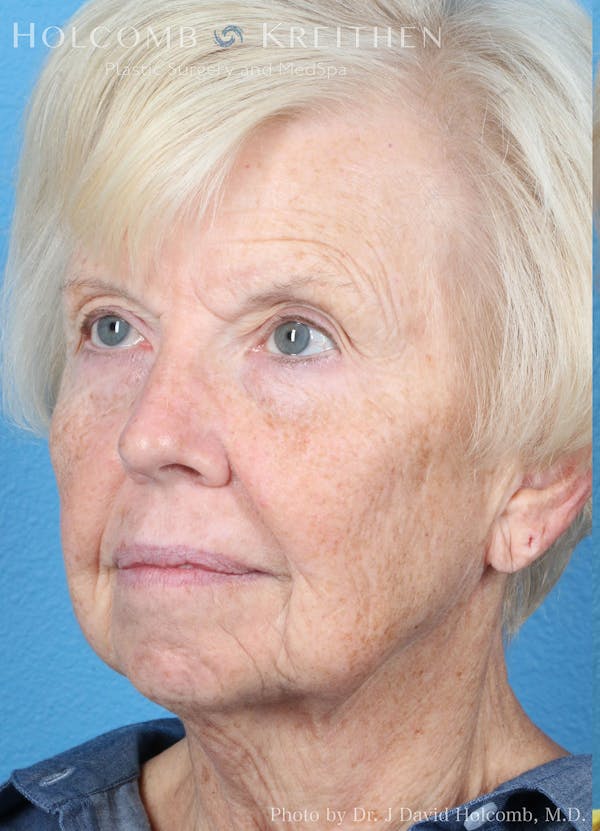 Energy Assisted Face/Neck Lift Before & After Gallery - Patient 122466386 - Image 3