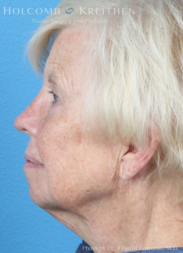 Energy Assisted Face/Neck Lift Before & After Gallery - Patient 122466386 - Image 5