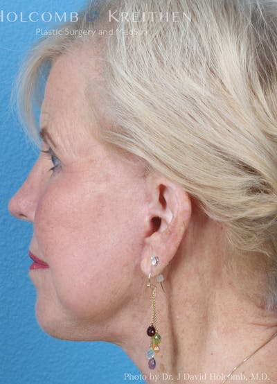 Energy Assisted Face/Neck Lift Before & After Gallery - Patient 122466386 - Image 6