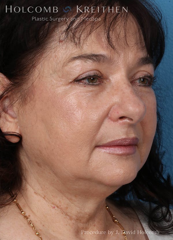 Energy Assisted Face/Neck Lift Before & After Gallery - Patient 122466392 - Image 3