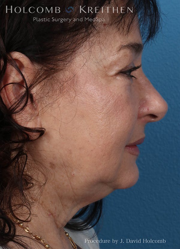 Energy Assisted Face/Neck Lift Before & After Gallery - Patient 122466392 - Image 5