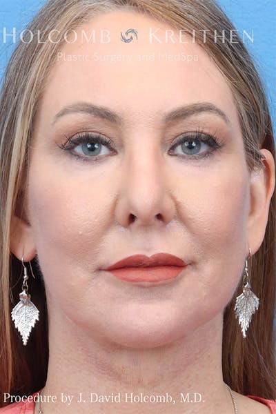 Energy Assisted Face/Neck Lift Before & After Gallery - Patient 122466890 - Image 2