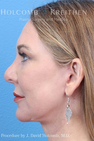 Energy Assisted Face/Neck Lift Before & After Gallery - Patient 122466890 - Image 4