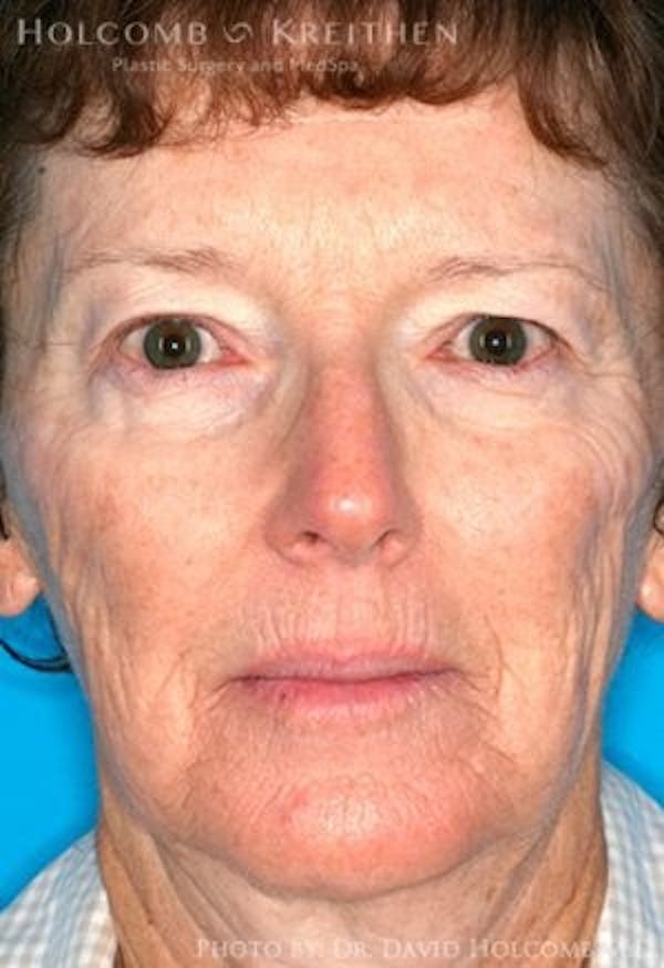 Energy Assisted Face/Neck Lift Before & After Gallery - Patient 122466891 - Image 1
