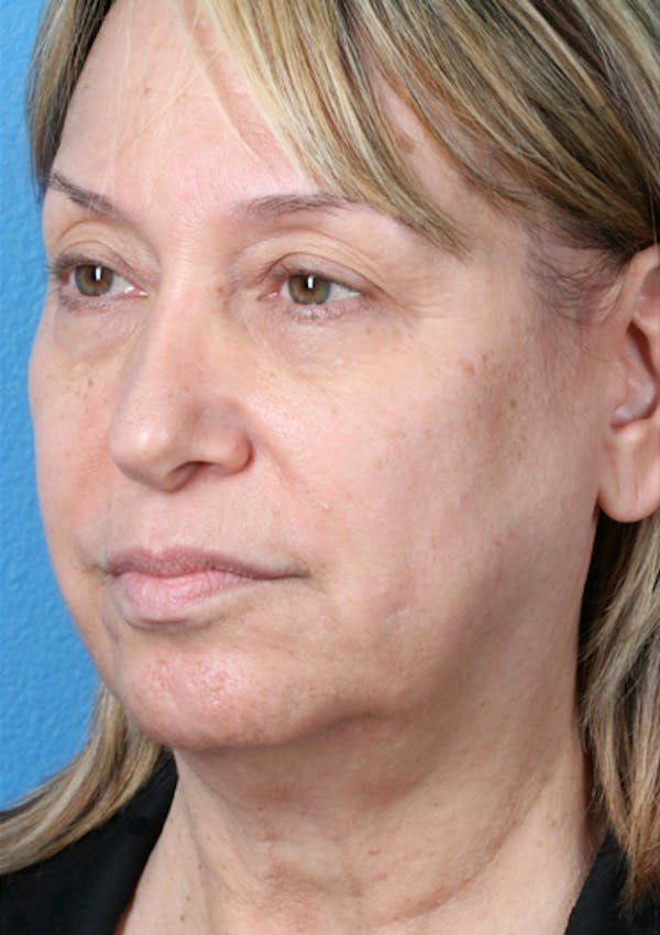 Energy Assisted Face/Neck Lift Before & After Gallery - Patient 122466957 - Image 3