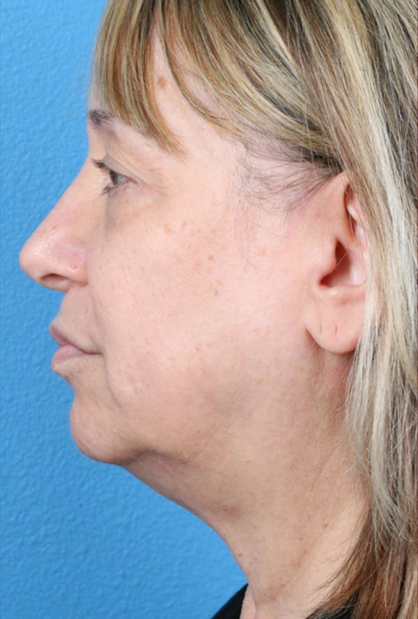 Energy Assisted Face/Neck Lift Before & After Gallery - Patient 122466957 - Image 5