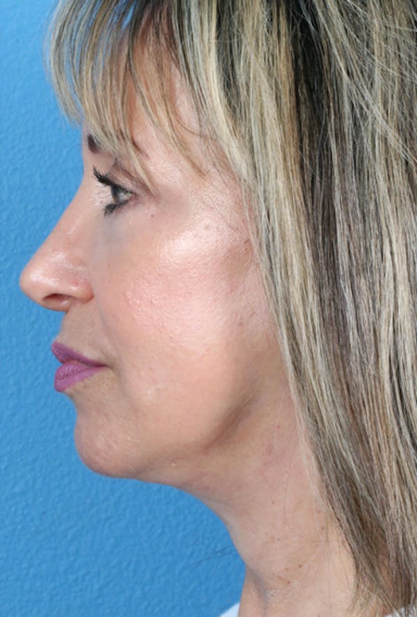 Energy Assisted Face/Neck Lift Before & After Gallery - Patient 122466957 - Image 6