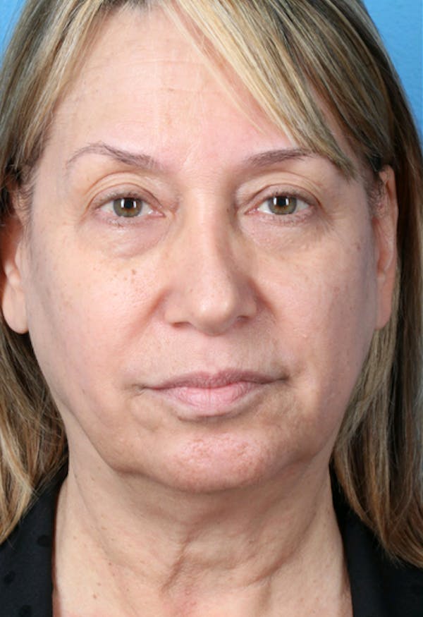 Energy Assisted Face/Neck Lift Before & After Gallery - Patient 122466957 - Image 1