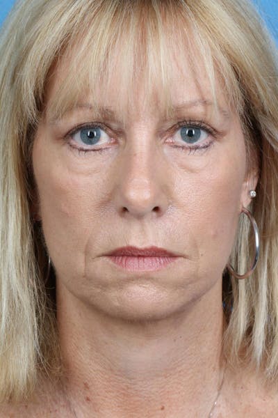 Energy Assisted Face/Neck Lift Gallery - Patient 122467096 - Image 2