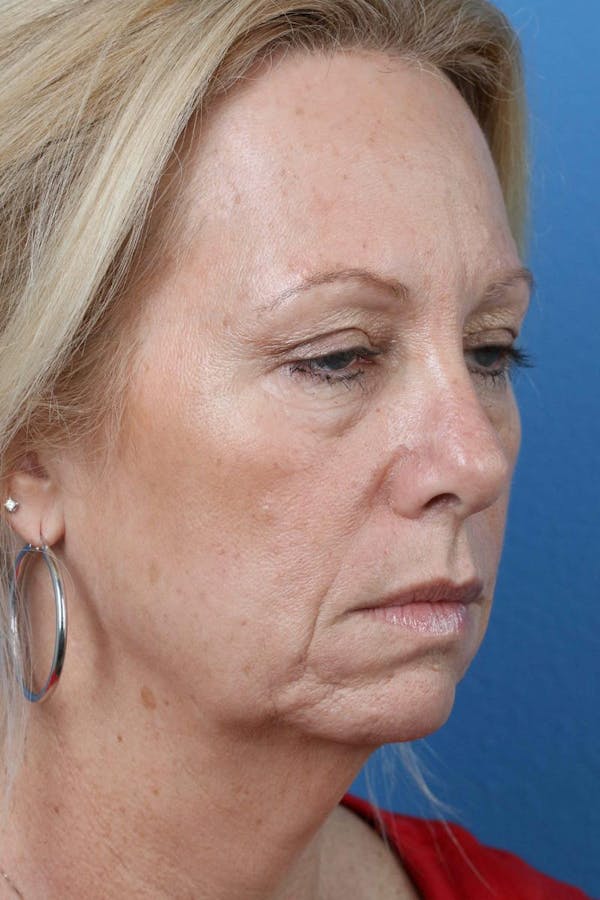 Energy Assisted Face/Neck Lift Before & After Gallery - Patient 122467096 - Image 3