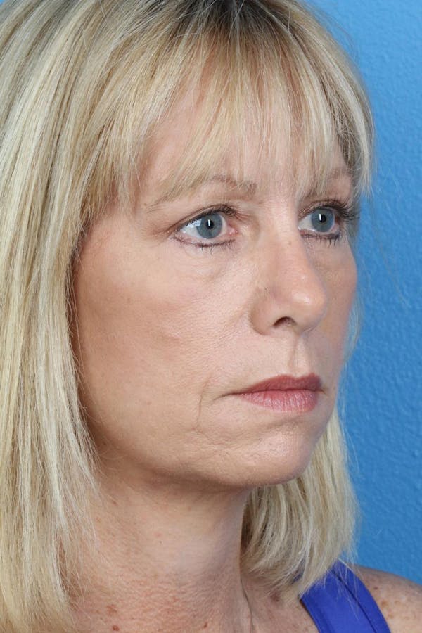 Energy Assisted Face/Neck Lift Before & After Gallery - Patient 122467096 - Image 4