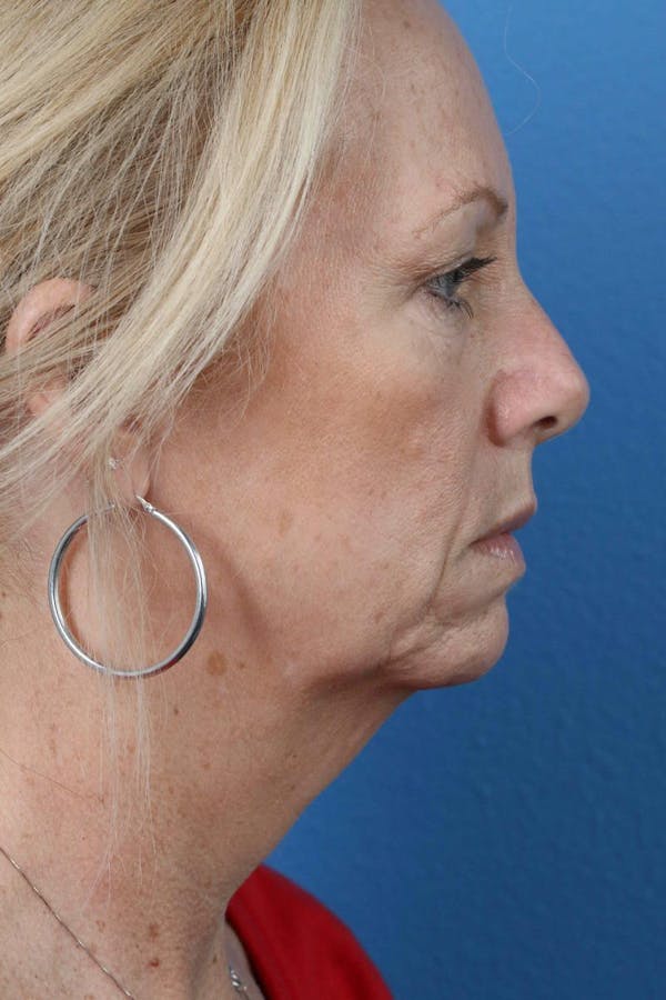 Energy Assisted Face/Neck Lift Before & After Gallery - Patient 122467096 - Image 5