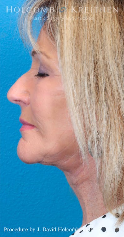 Energy Assisted Face/Neck Lift Before & After Gallery - Patient 122467363 - Image 4