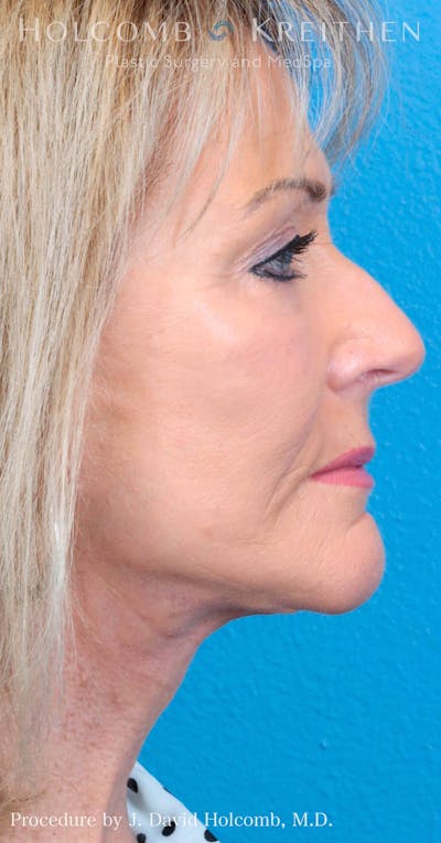 Energy Assisted Face/Neck Lift Before & After Gallery - Patient 122467363 - Image 10