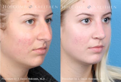 Rhinoplasty Before & After Gallery - Patient 122749626 - Image 2
