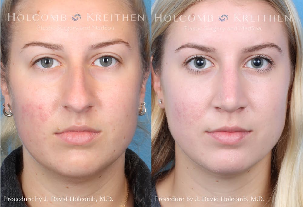 Rhinoplasty Before & After Gallery - Patient 122749626 - Image 1