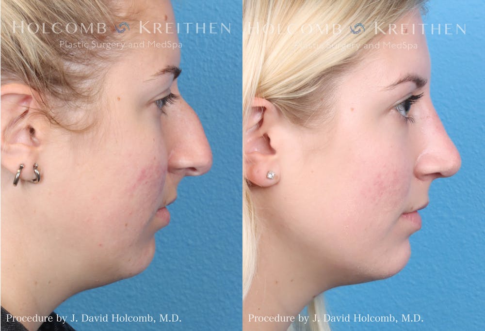 Rhinoplasty Before & After Gallery - Patient 122749626 - Image 3