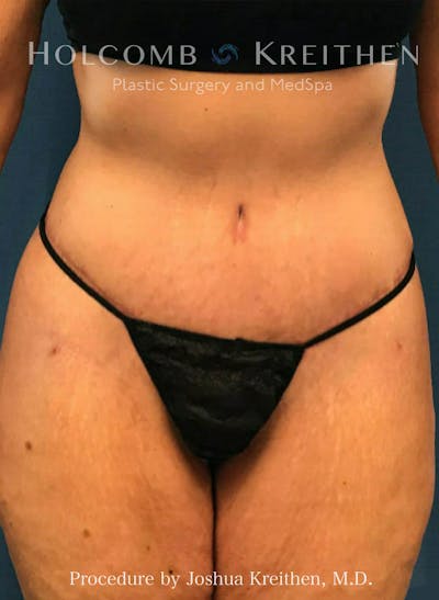 Lower Body Lift Before & After Gallery - Patient 123699833 - Image 2