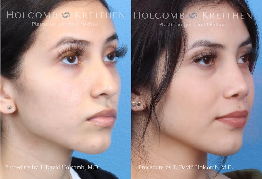 Rhinoplasty Before & After Gallery - Patient 144711544 - Image 1