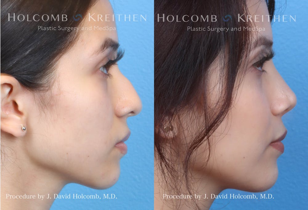 Rhinoplasty Before & After Gallery - Patient 144711544 - Image 2