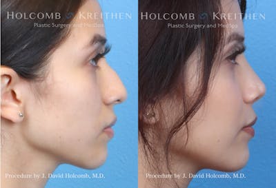 Rhinoplasty Before & After Gallery - Patient 144711544 - Image 2