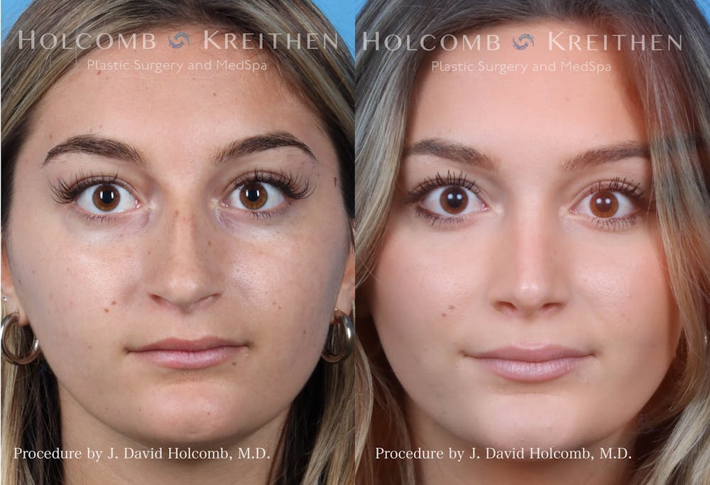 Rhinoplasty Before & After Gallery - Patient 144711543 - Image 1