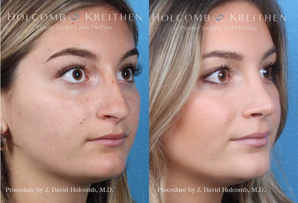 Rhinoplasty Before & After Gallery - Patient 144711543 - Image 2