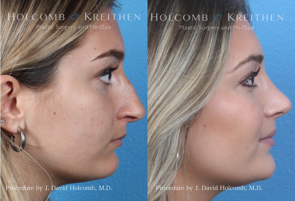 Rhinoplasty Before & After Gallery - Patient 144711543 - Image 3
