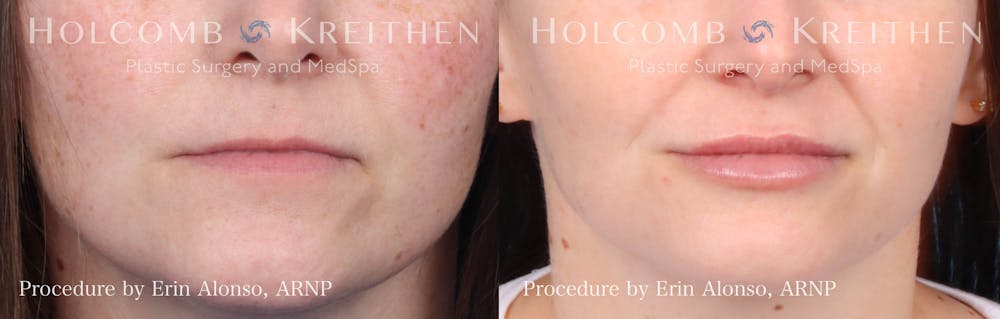 Fillers Before & After Gallery - Patient 146362340 - Image 1