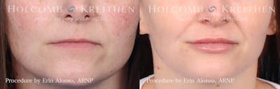 Fillers Before & After Gallery - Patient 146362340 - Image 1