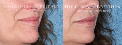 Fillers Before & After Gallery - Patient 147033651 - Image 1