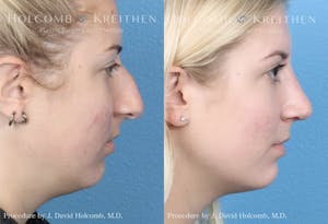 Rhinoplasty in Tampa Before & After Photos