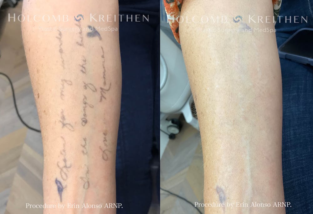 PicoPlus Tattoo Removal Before & After Gallery - Patient 147416981 - Image 1