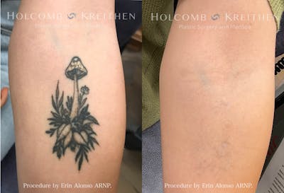 PicoPlus Tattoo Removal Before & After Gallery - Patient 147416985 - Image 1
