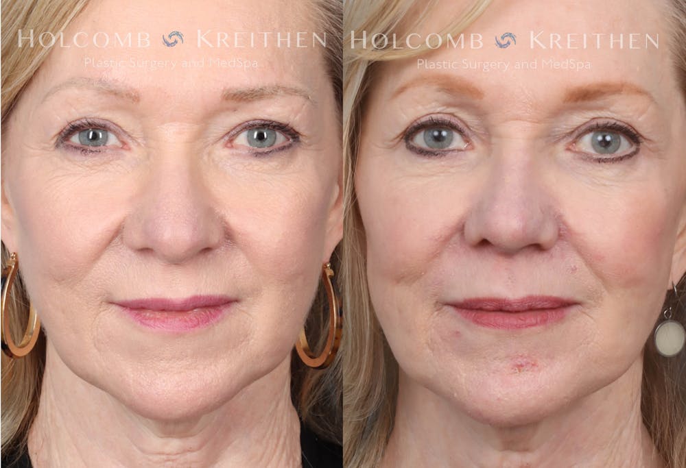 Rhinoplasty Before & After Gallery - Patient 147739247 - Image 1