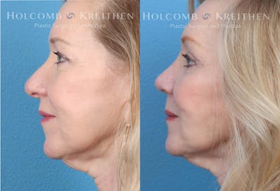 Rhinoplasty Before & After Gallery - Patient 147739247 - Image 4