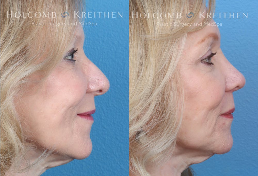 Rhinoplasty Before & After Gallery - Patient 147739247 - Image 3