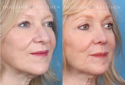 Rhinoplasty Before & After Gallery - Patient 147739247 - Image 2