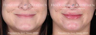 Fillers Before & After Gallery - Patient 148314210 - Image 1