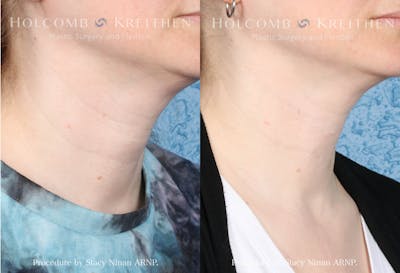 Fillers Before & After Gallery - Patient 149236349 - Image 1