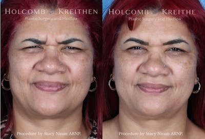 BOTOX Before & After Gallery - Patient 149236346 - Image 1