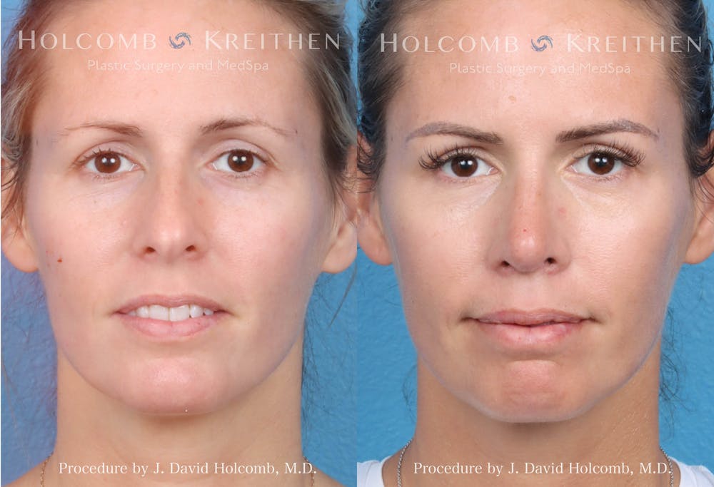 Rhinoplasty Before & After Gallery - Patient 149236352 - Image 1