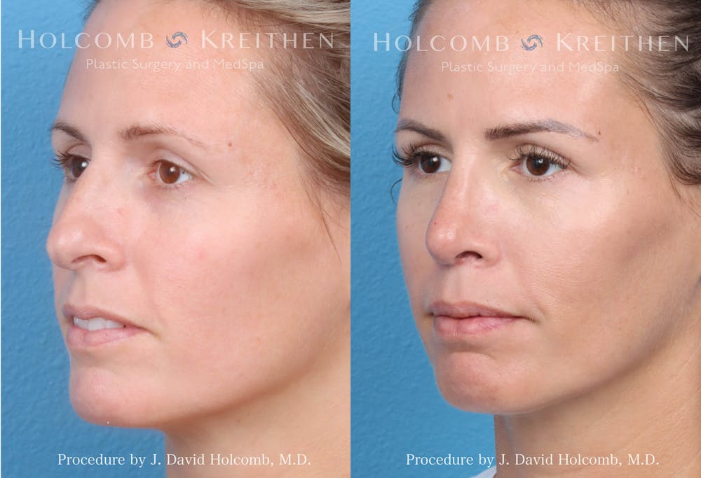 Rhinoplasty Before & After Gallery - Patient 149236352 - Image 2