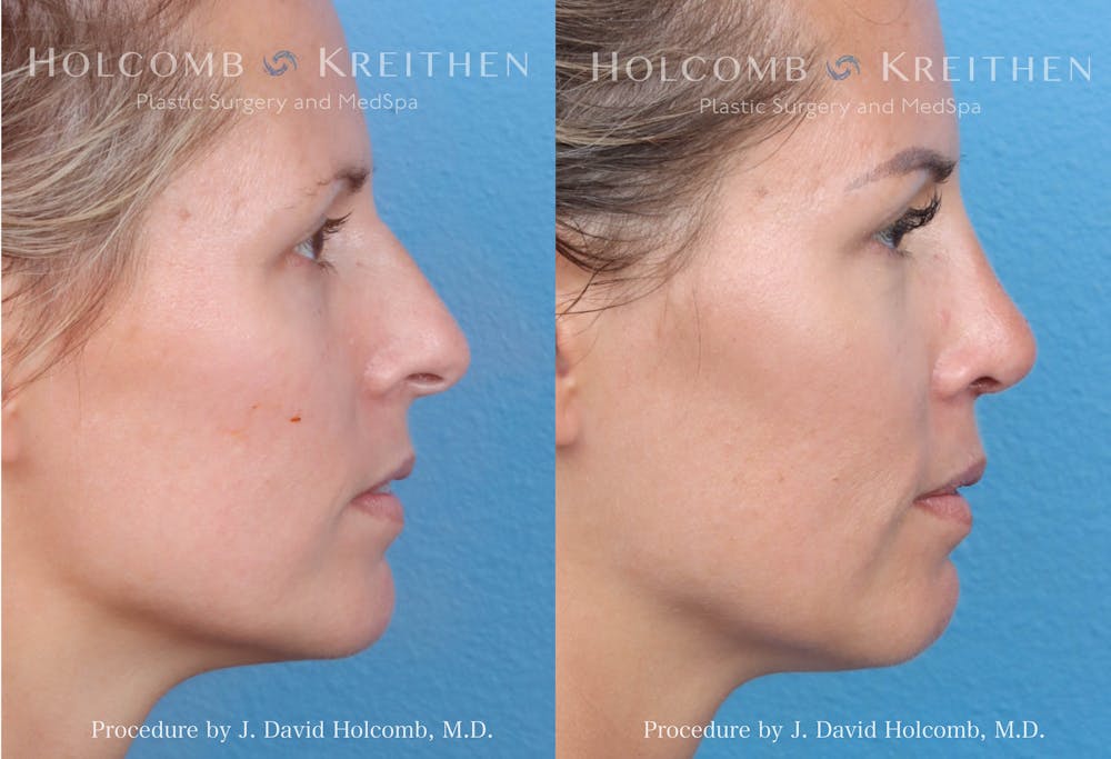 Rhinoplasty Before & After Gallery - Patient 149236352 - Image 3
