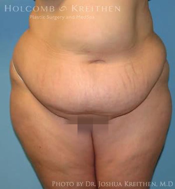 Tummy Tuck Before & After Gallery - Patient 6236446 - Image 1