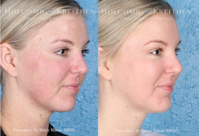 Cosmelan Before & After Gallery - Patient 152705187 - Image 2