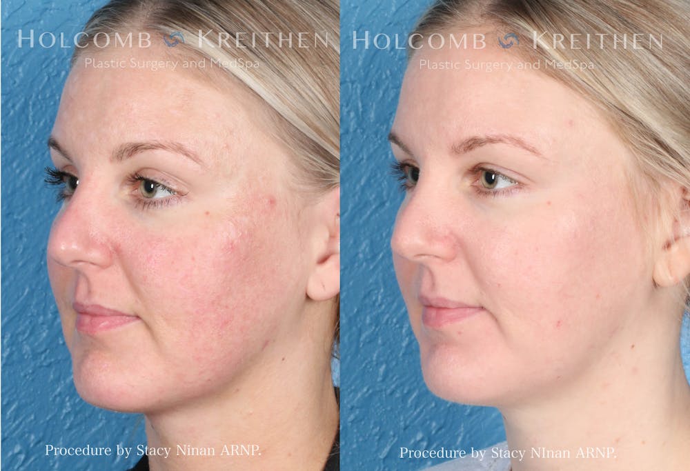 Cosmelan Before & After Gallery - Patient 152705187 - Image 3