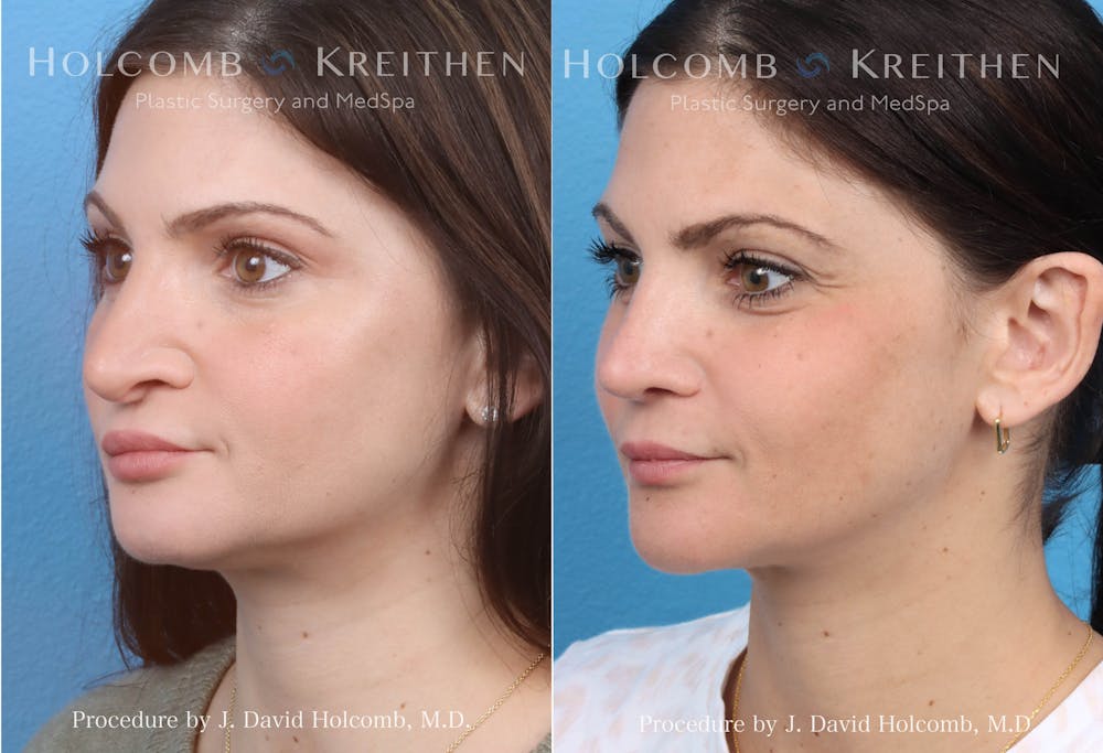 Rhinoplasty Before & After Gallery - Patient 152705191 - Image 1