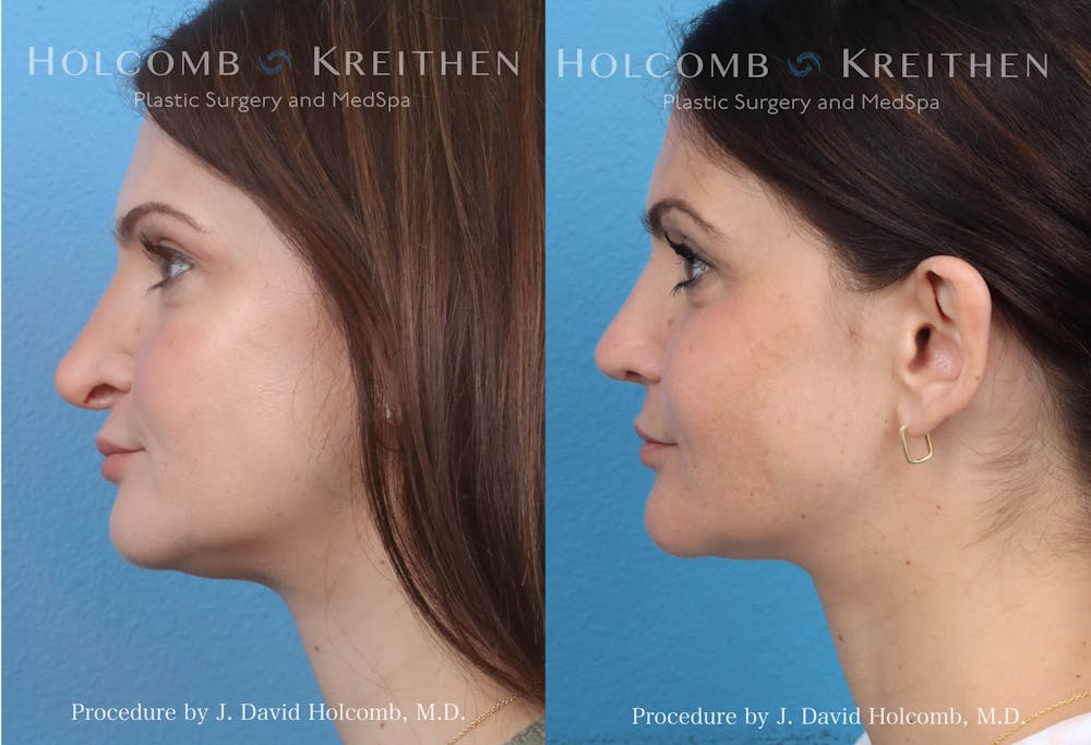 Rhinoplasty Before & After Gallery - Patient 152705191 - Image 2