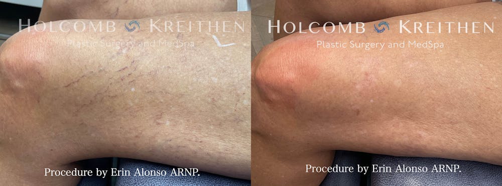 Excel V Vascular Laser Before & After Gallery - Patient 154108479 - Image 1